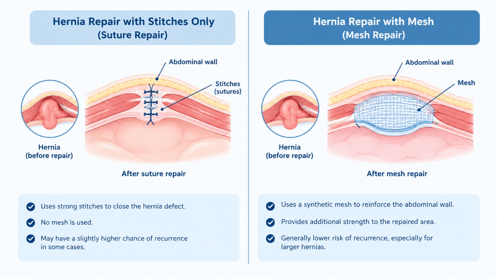 Hernia repair with stitches only compared with mesh repair