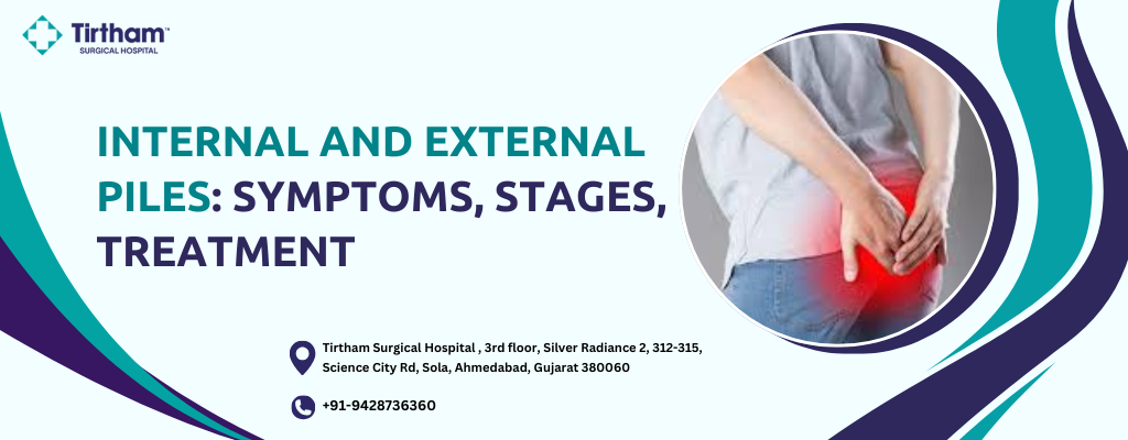 Internal and External Piles: Symptoms, Stages, Treatment