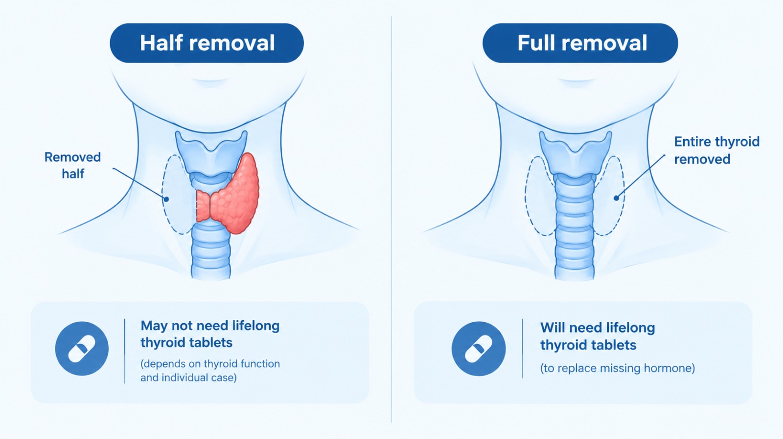 Comparison of half thyroid removal and total thyroid removal and the need for tablets
