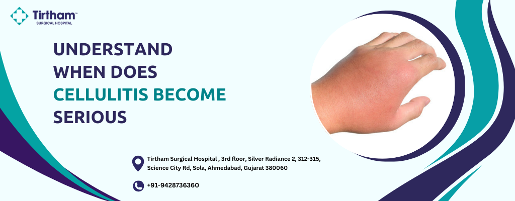Understand Cellulitis